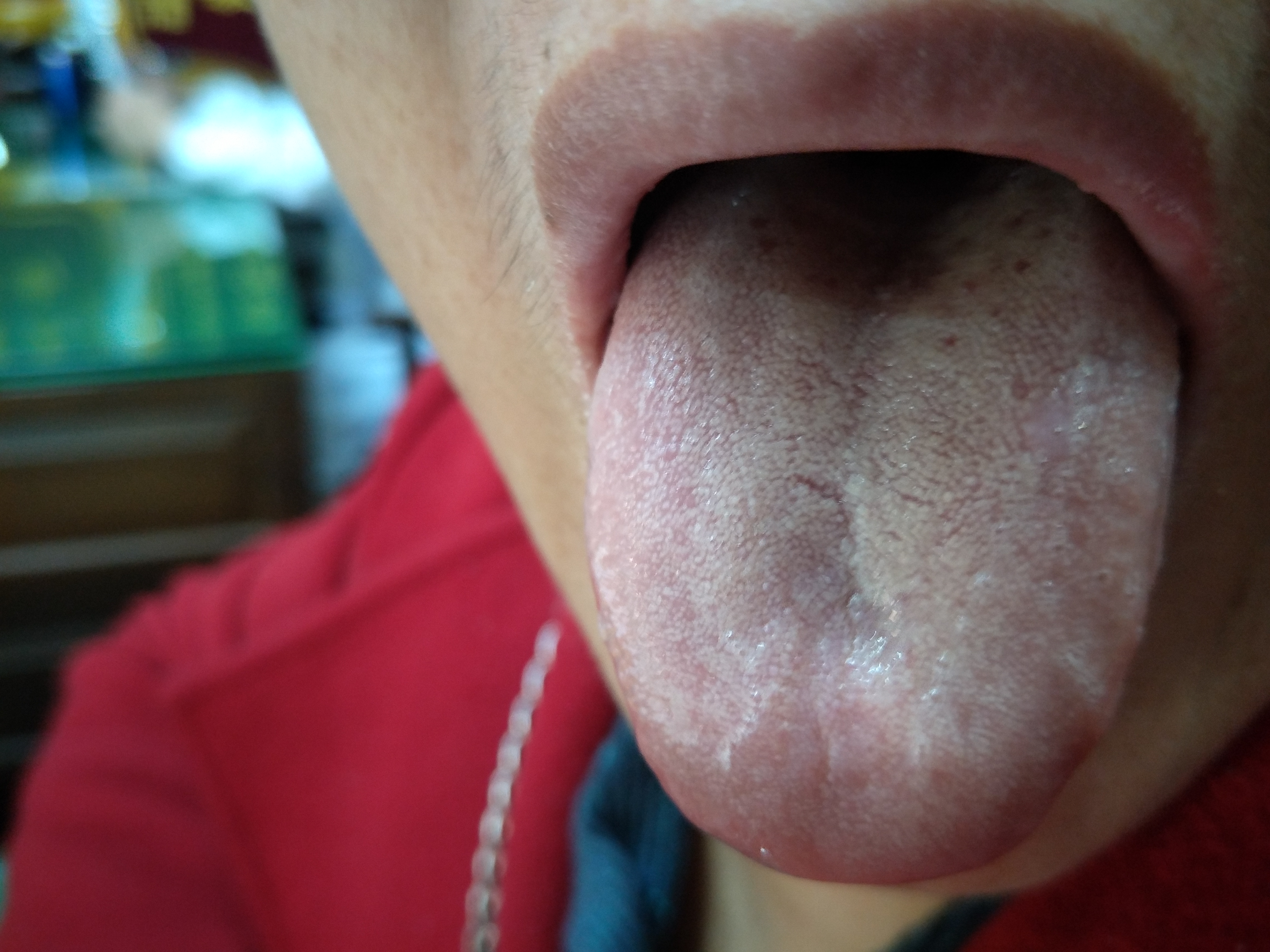 女，58岁，头晕6月余 舌面.jpg