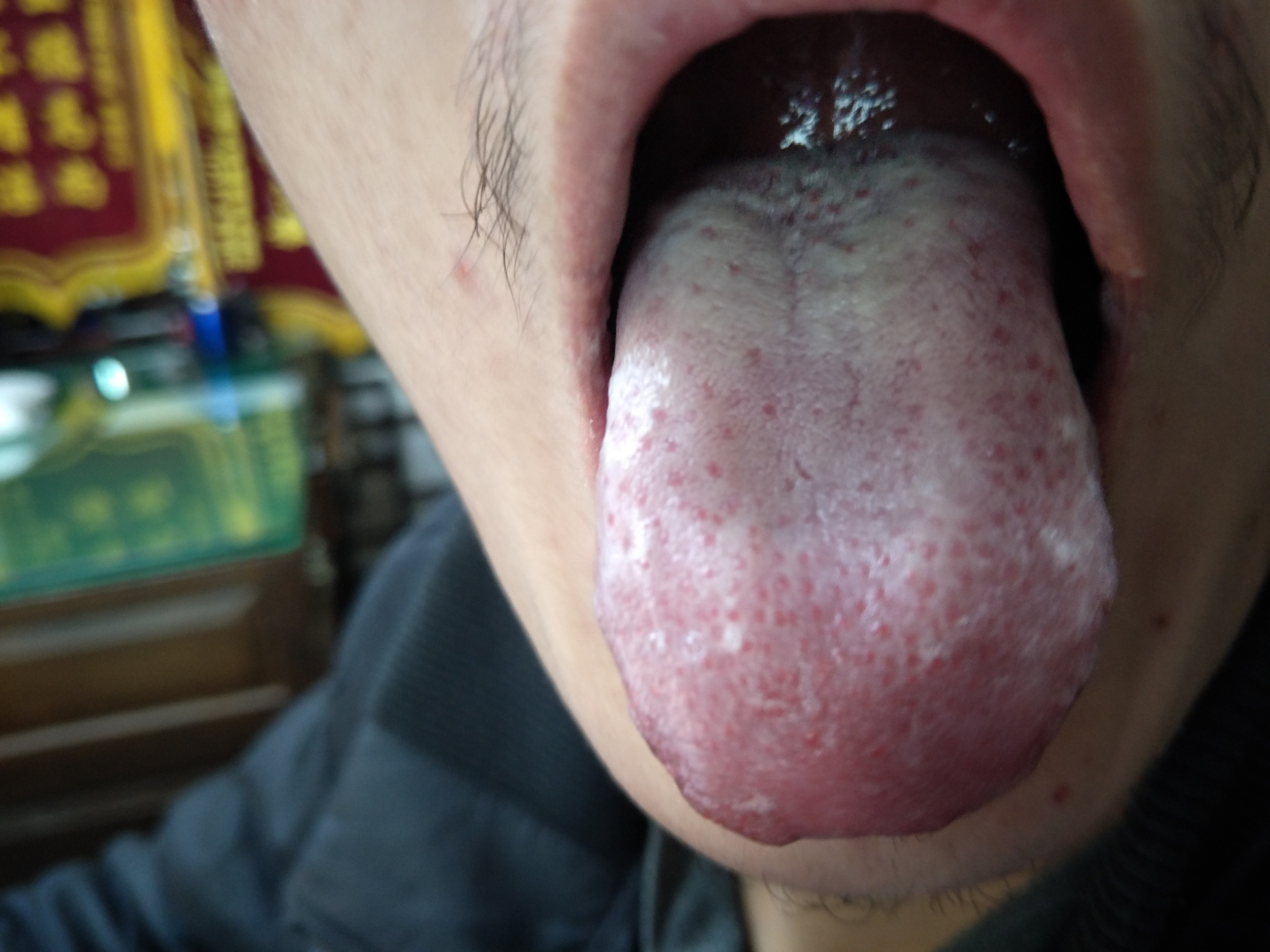 女，66岁，胃痛半月余 舌面.jpg