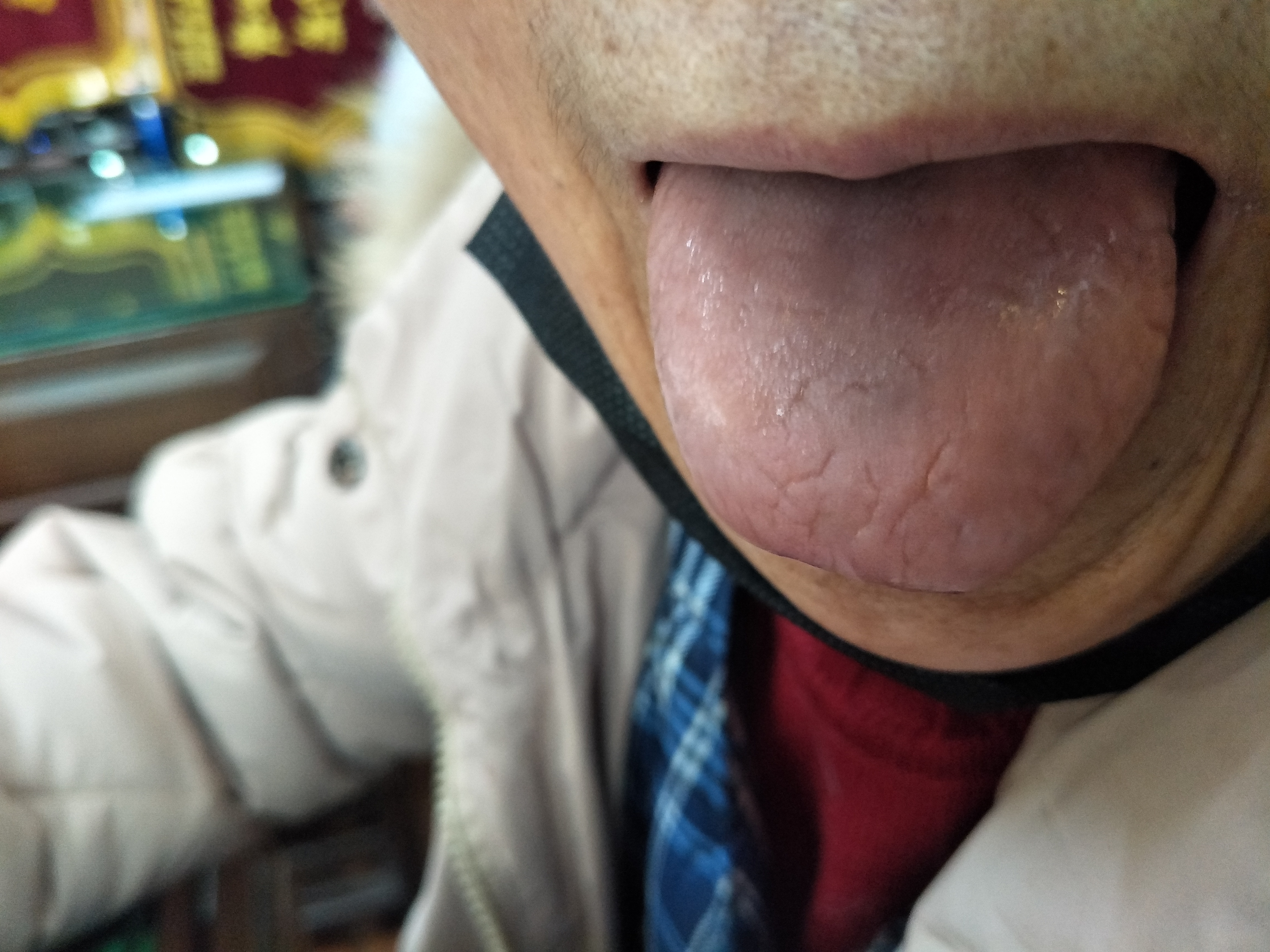 女，75岁，反复心慌胸闷近8年 舌面.jpg