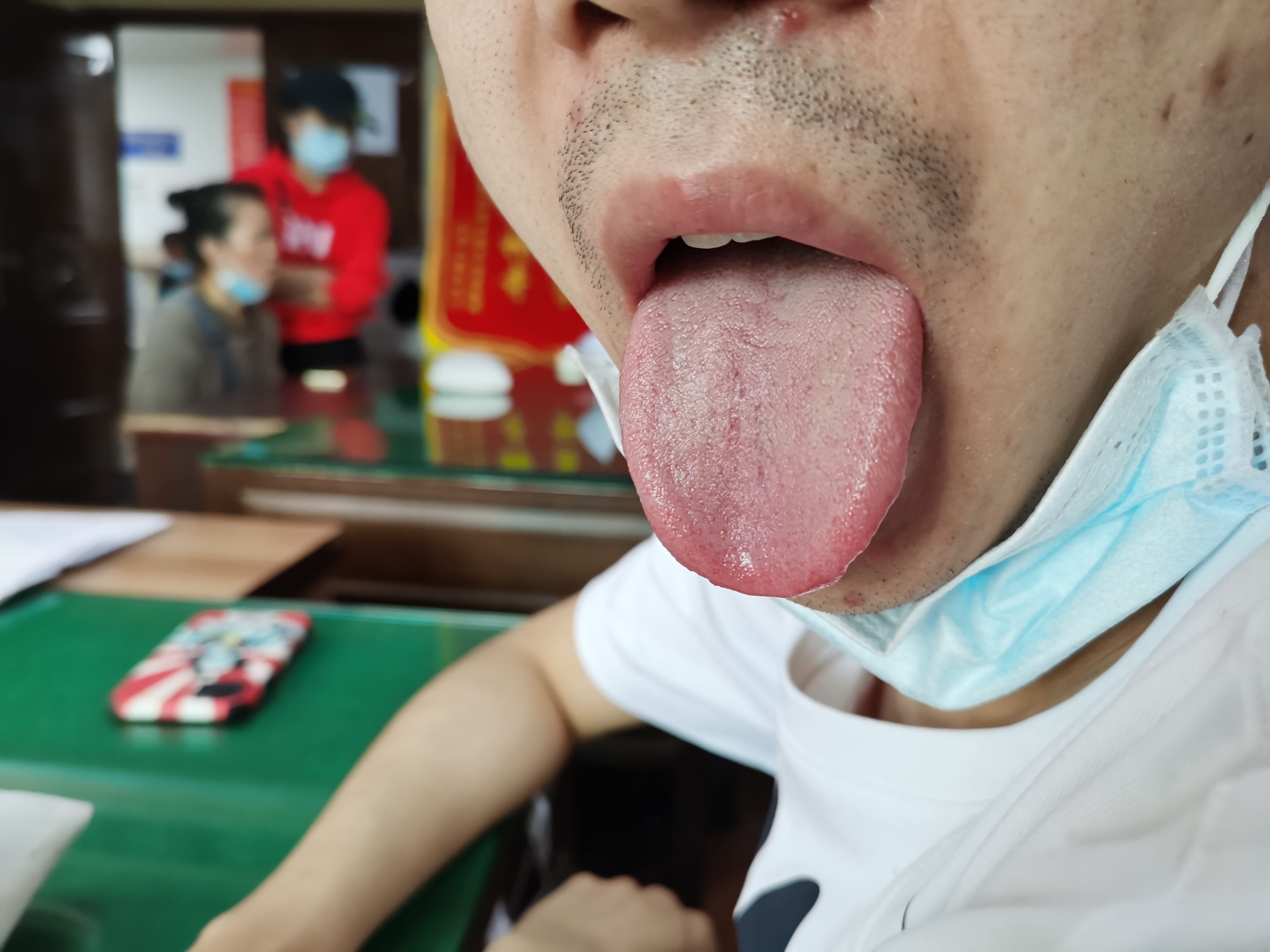 男，25岁，双下肢乏力4年 舌面.jpg