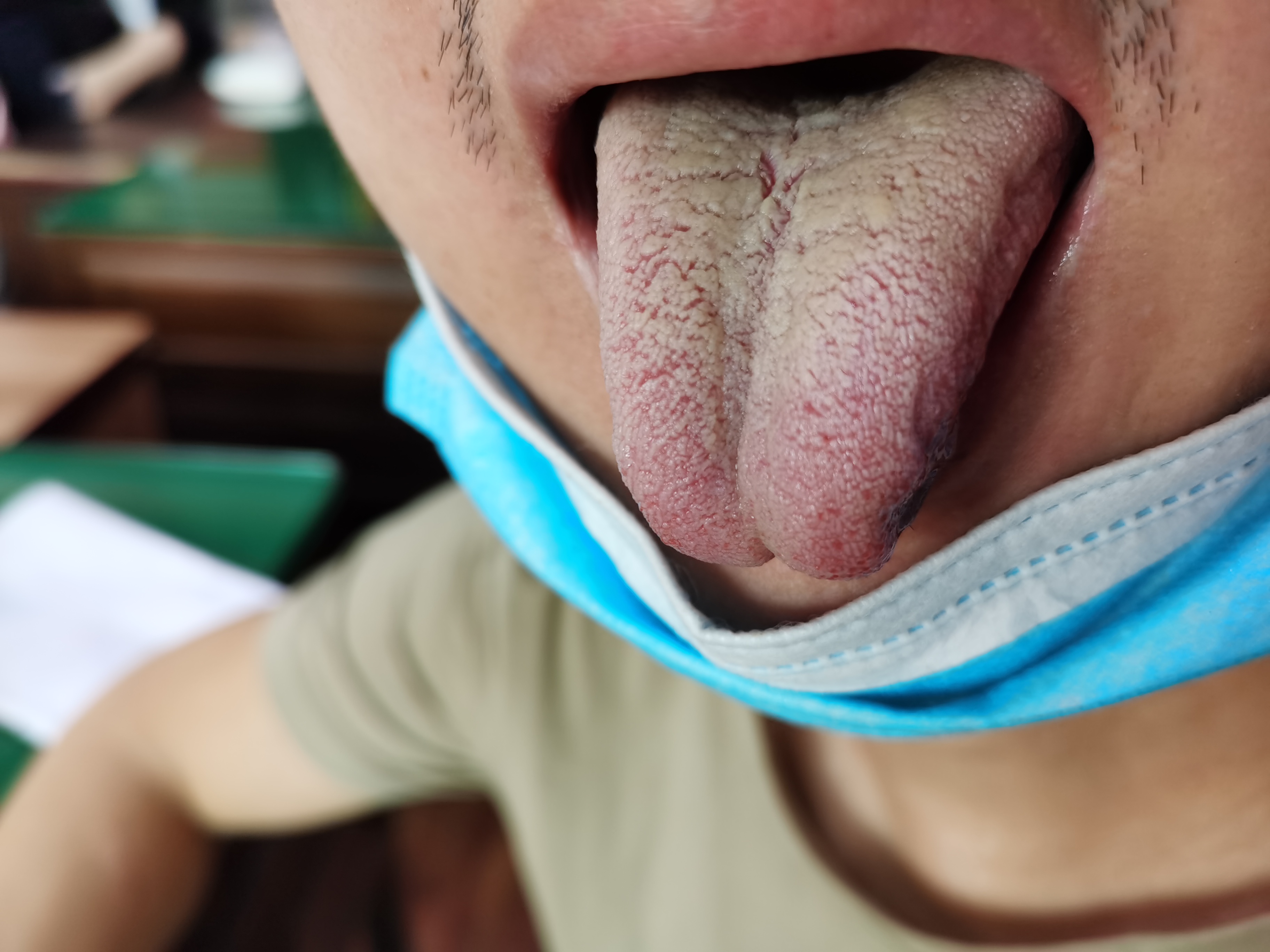 男，36岁，肌肉萎缩8年余 舌面.jpg