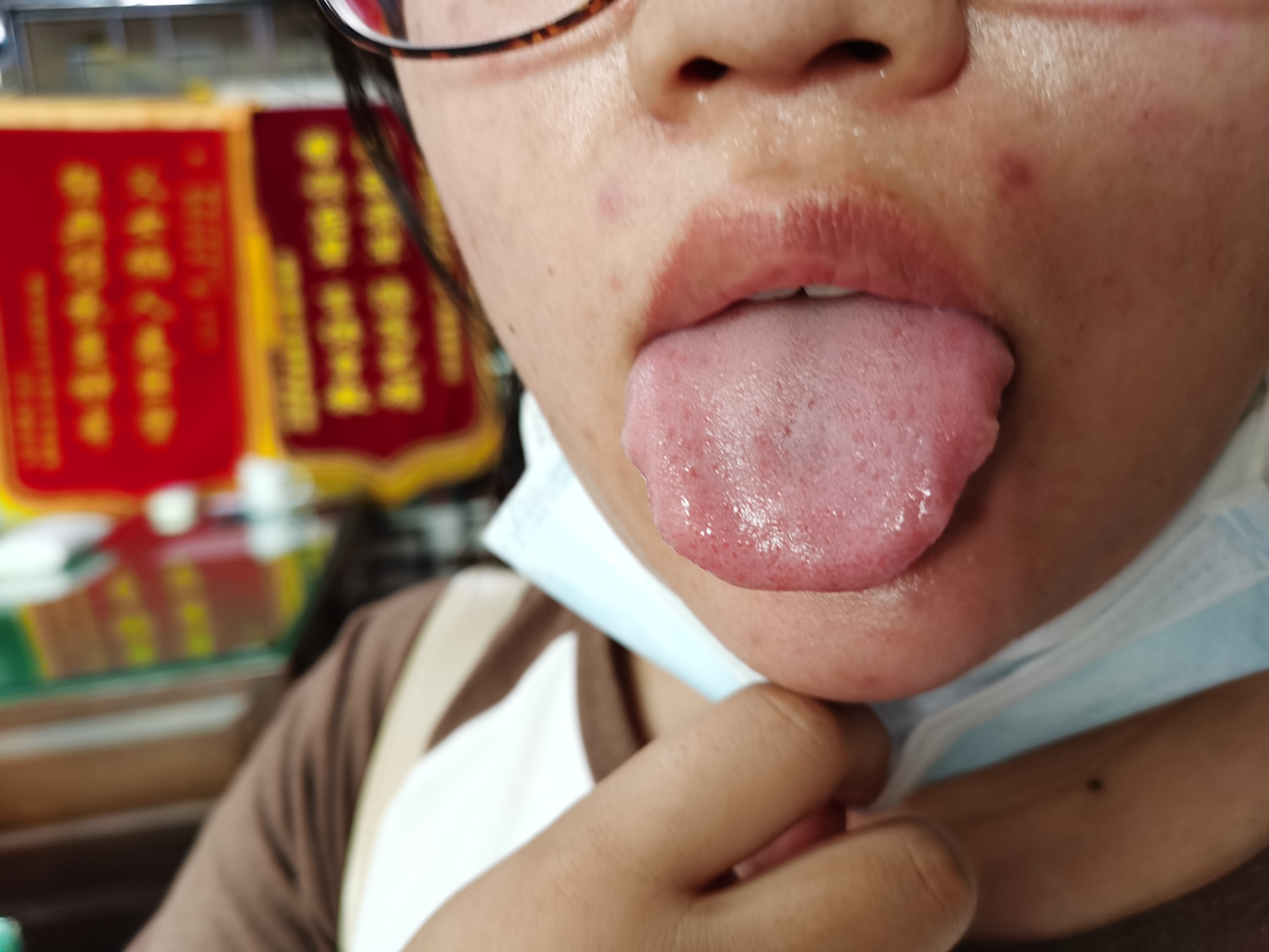 女，23岁，心慌胸闷10月余 舌面.jpg