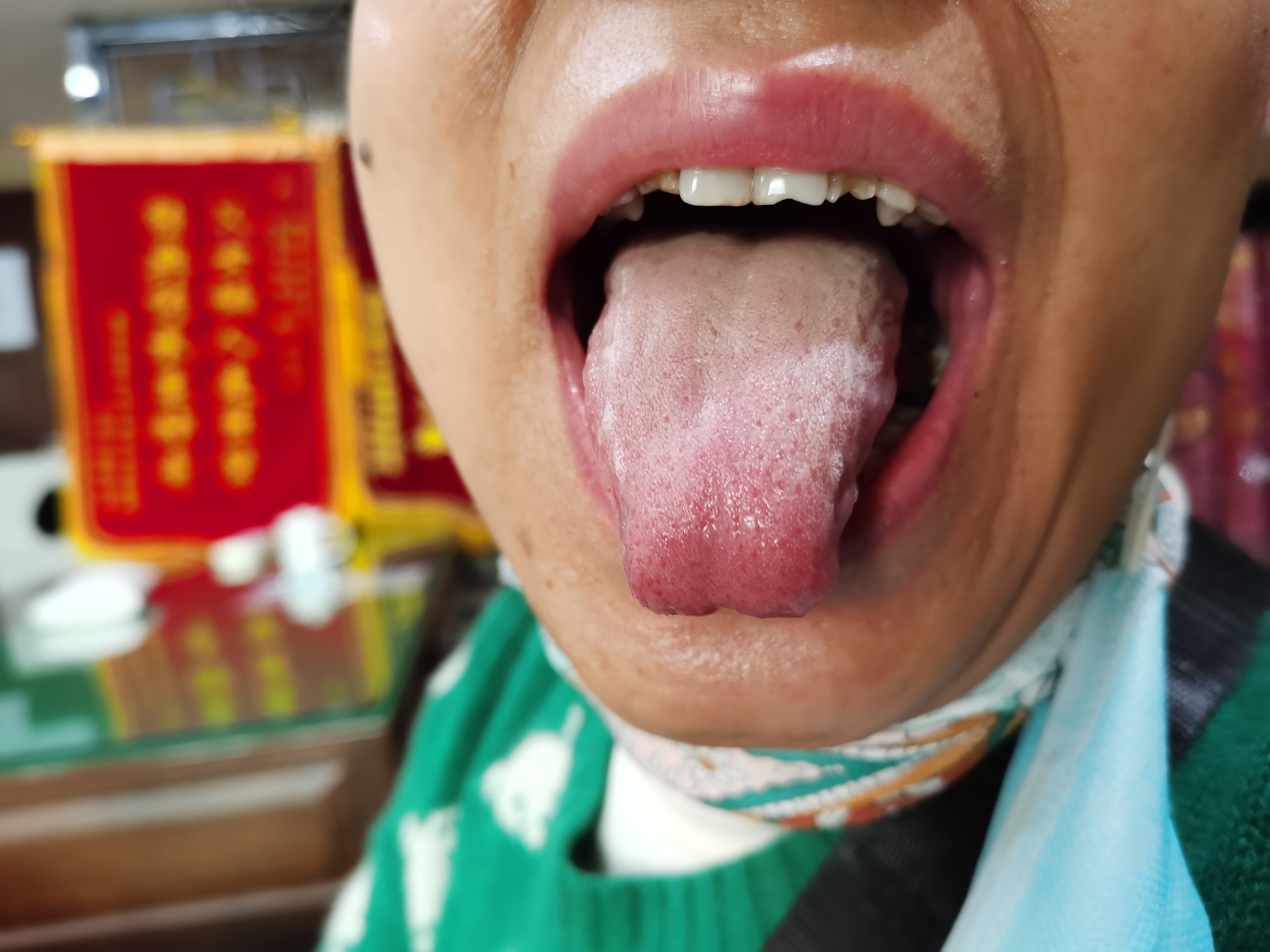 女，47岁，肺癌术后我4月，胃部不适1年余 舌面.jpg