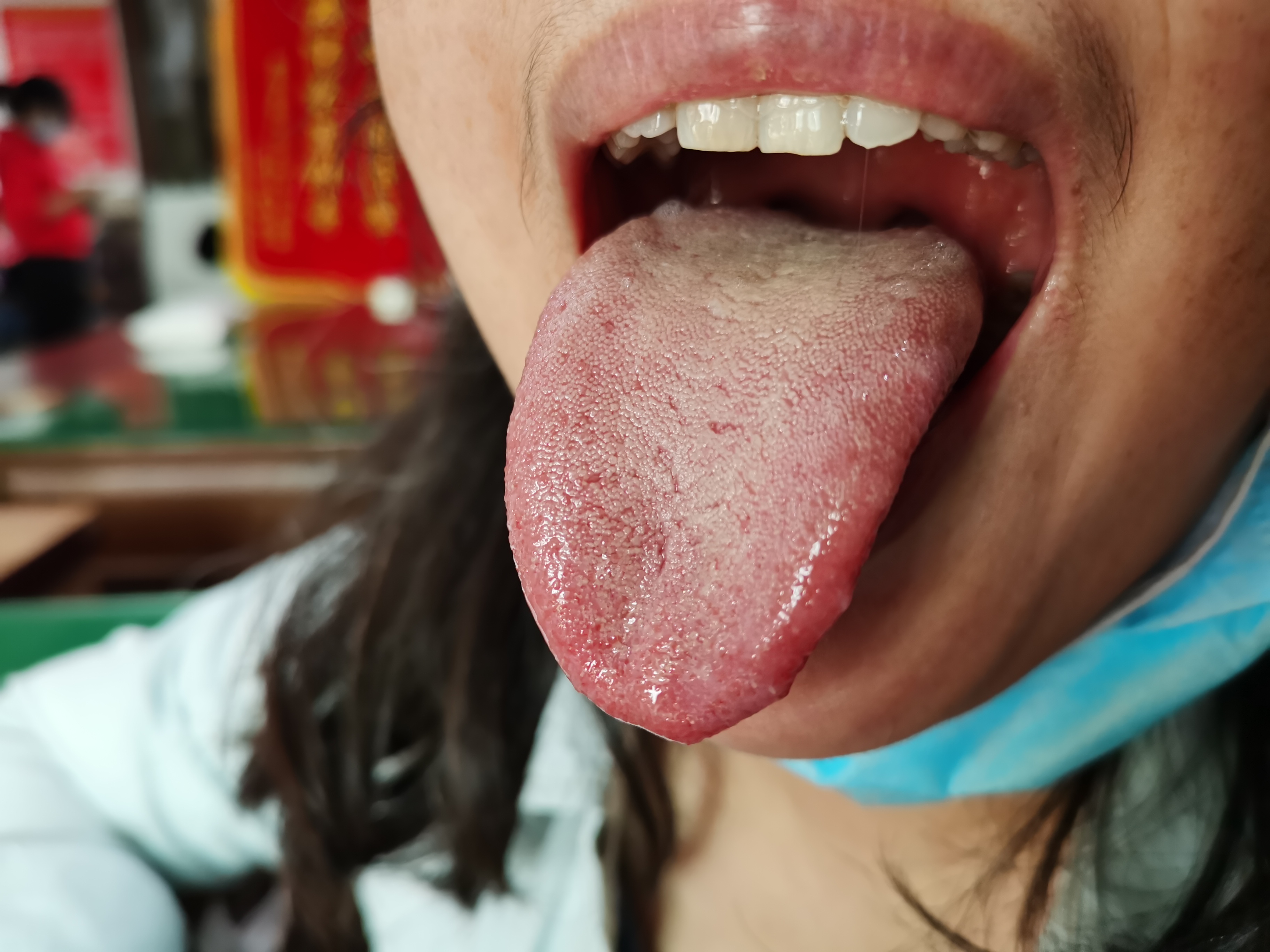 女，47岁右侧胁肋灼热感1年  舌面.jpg