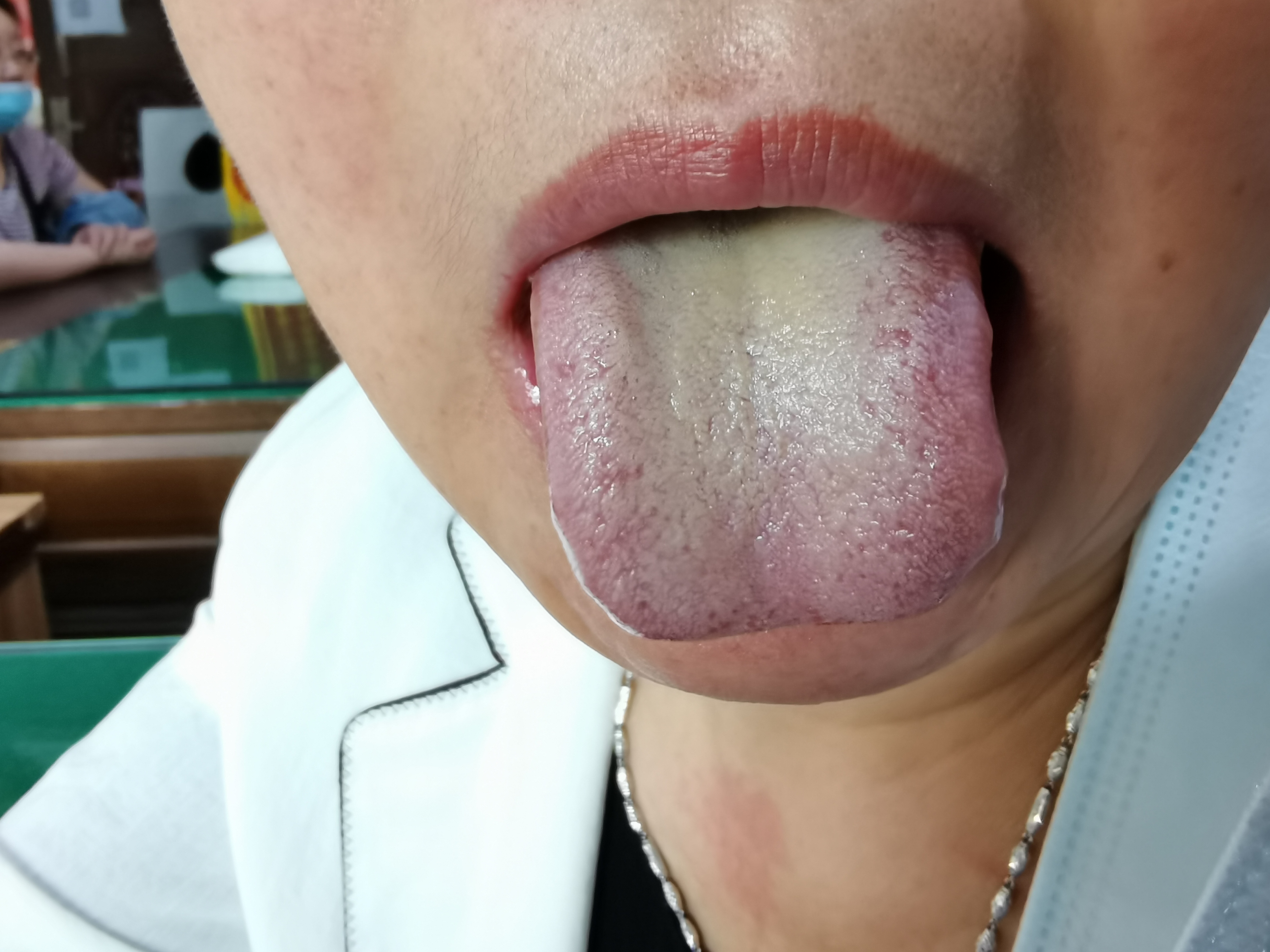 女，49岁，失眠，肺癌 舌面.jpg