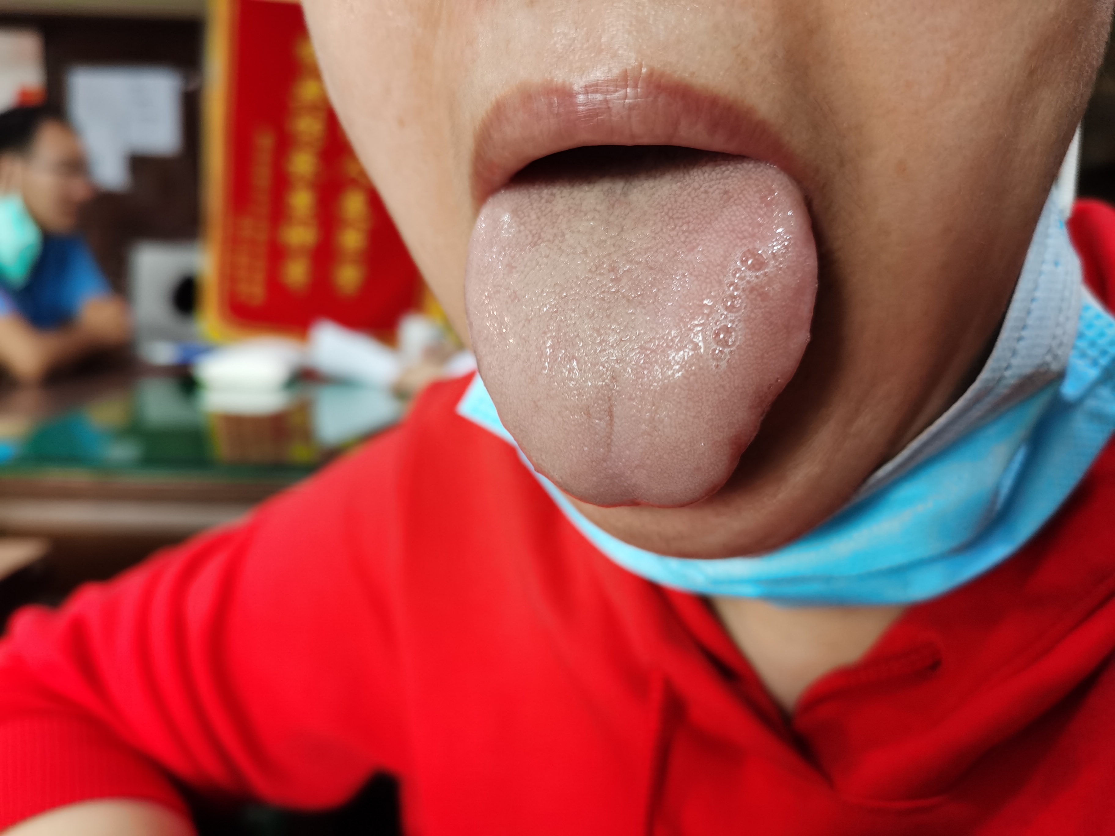 女，50岁，手足关节僵硬1年 舌面.jpg