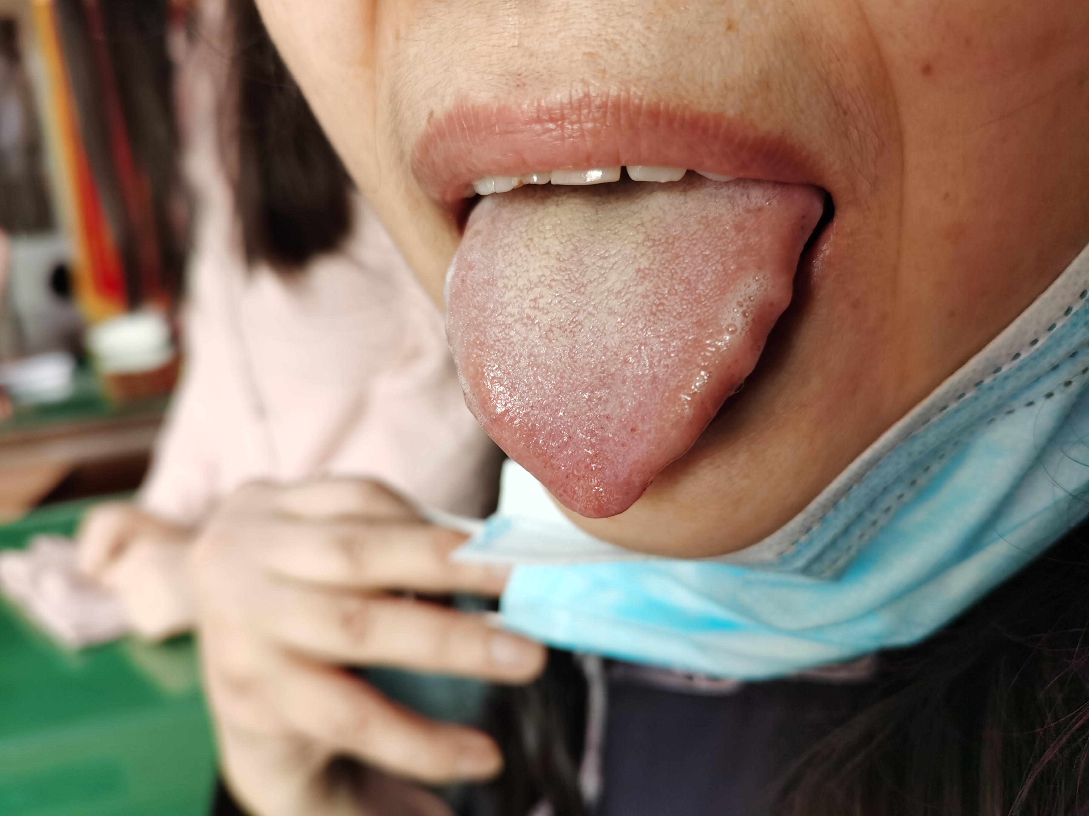 女，50岁，诊断RA14余年  舌面.jpg