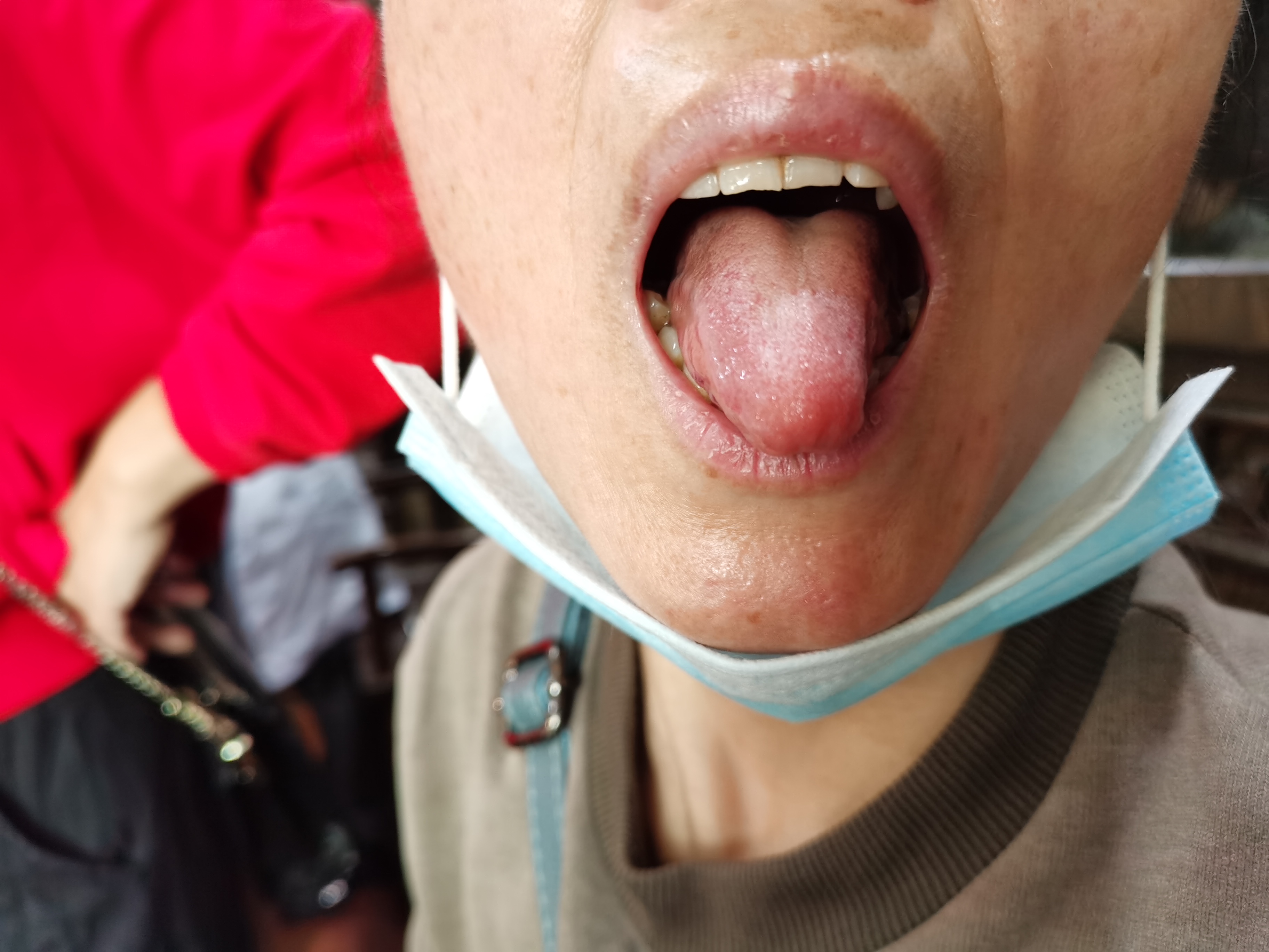 女，52岁，眠浅多梦易醒6年  舌下.jpg