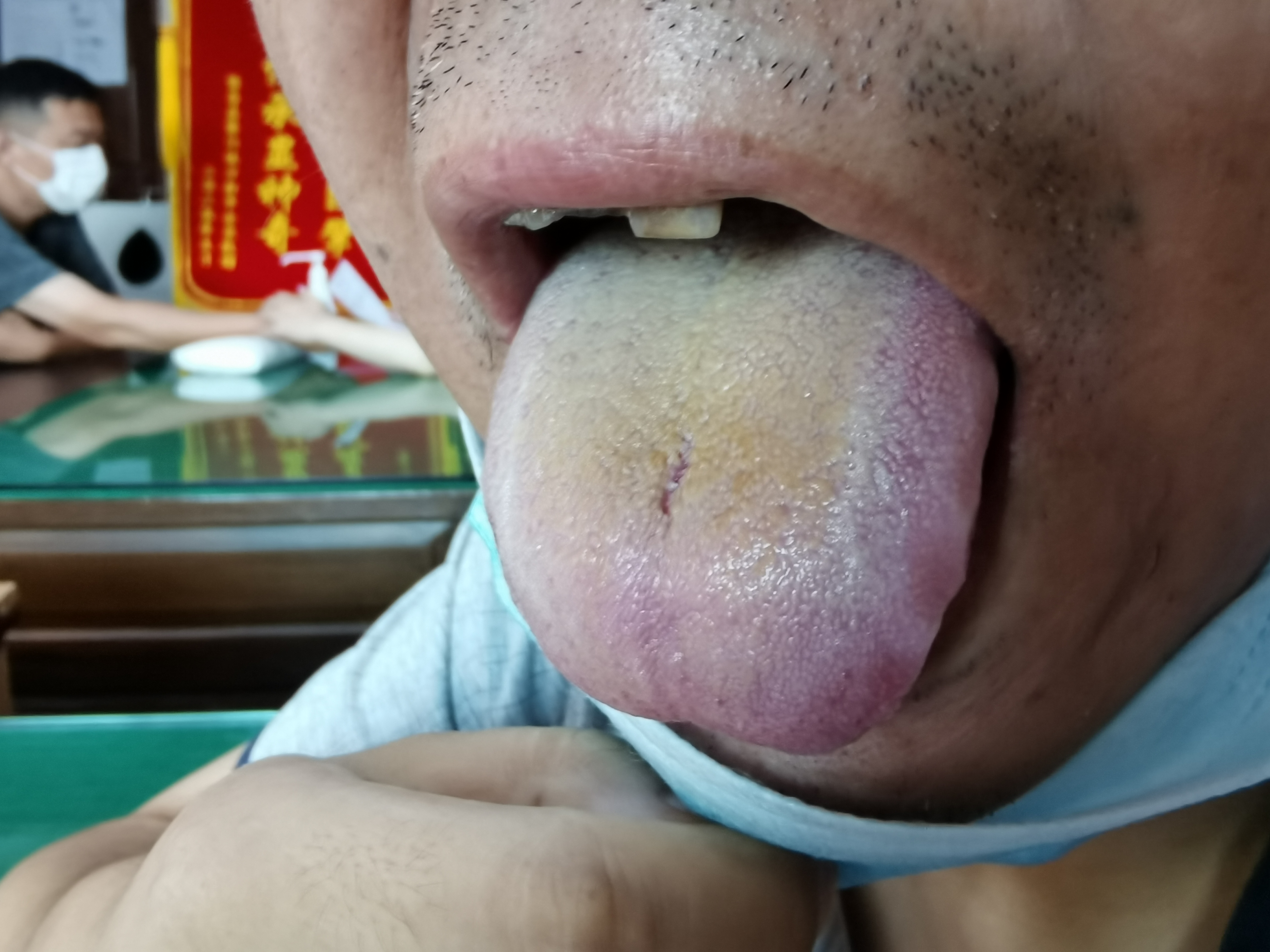 男，48岁，头晕30余年 舌面.jpg