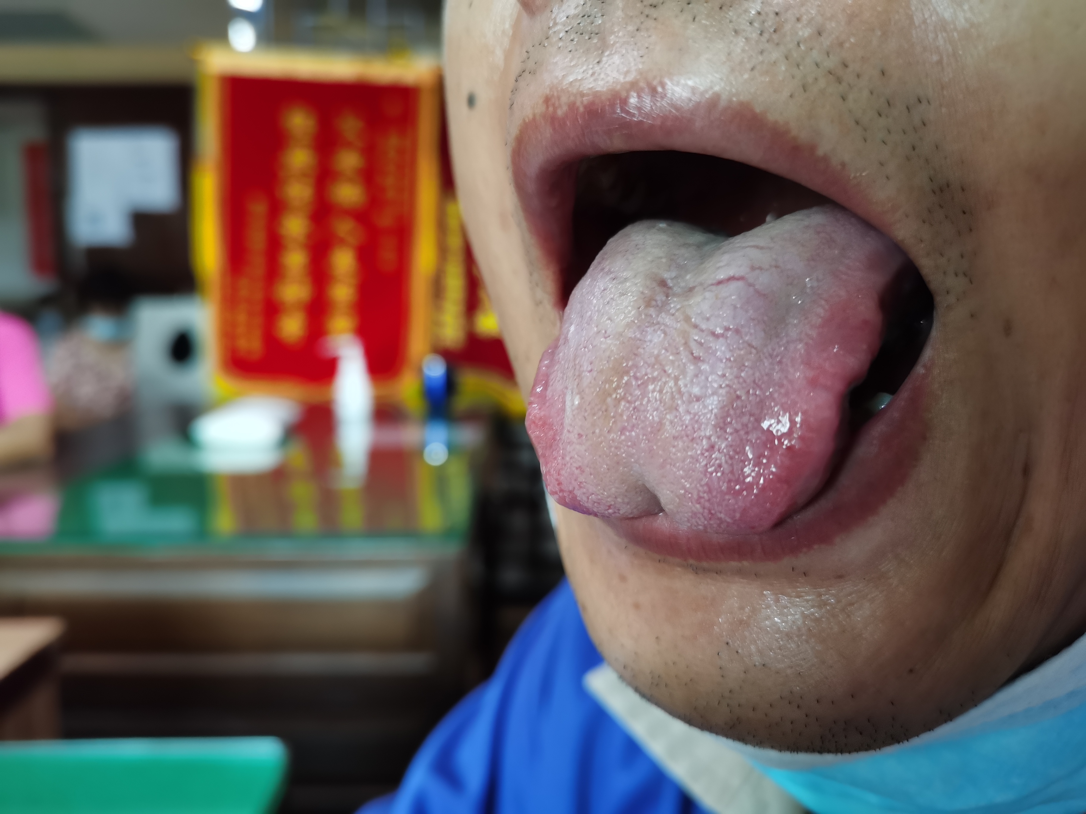 男，50岁，全身肌肉酸胀疼痛6年余 舌面.jpg