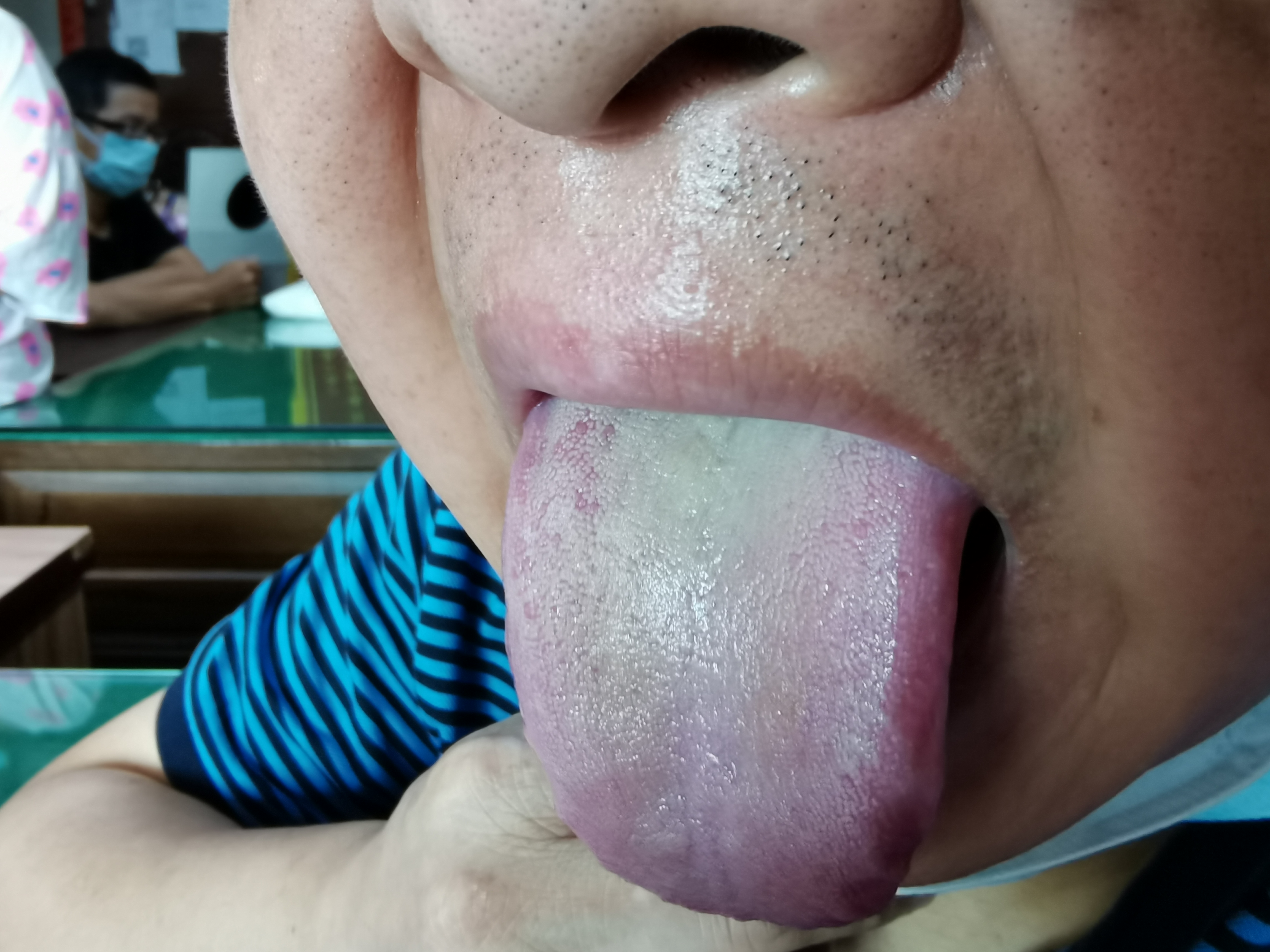 男，51岁，耳鸣7年余 舌面.jpg