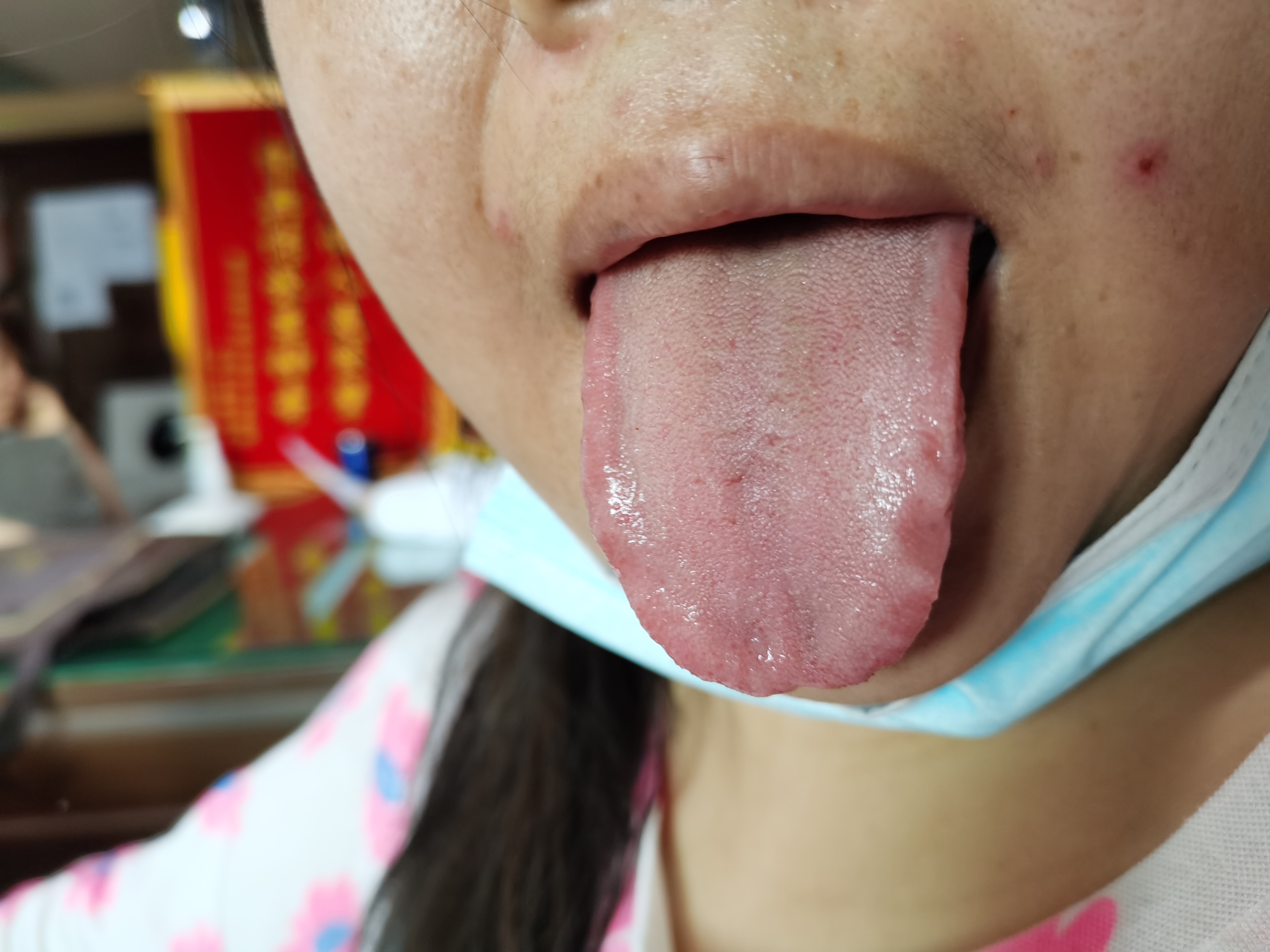 女，34岁，脚尖无法抬起4年余 舌面.jpg