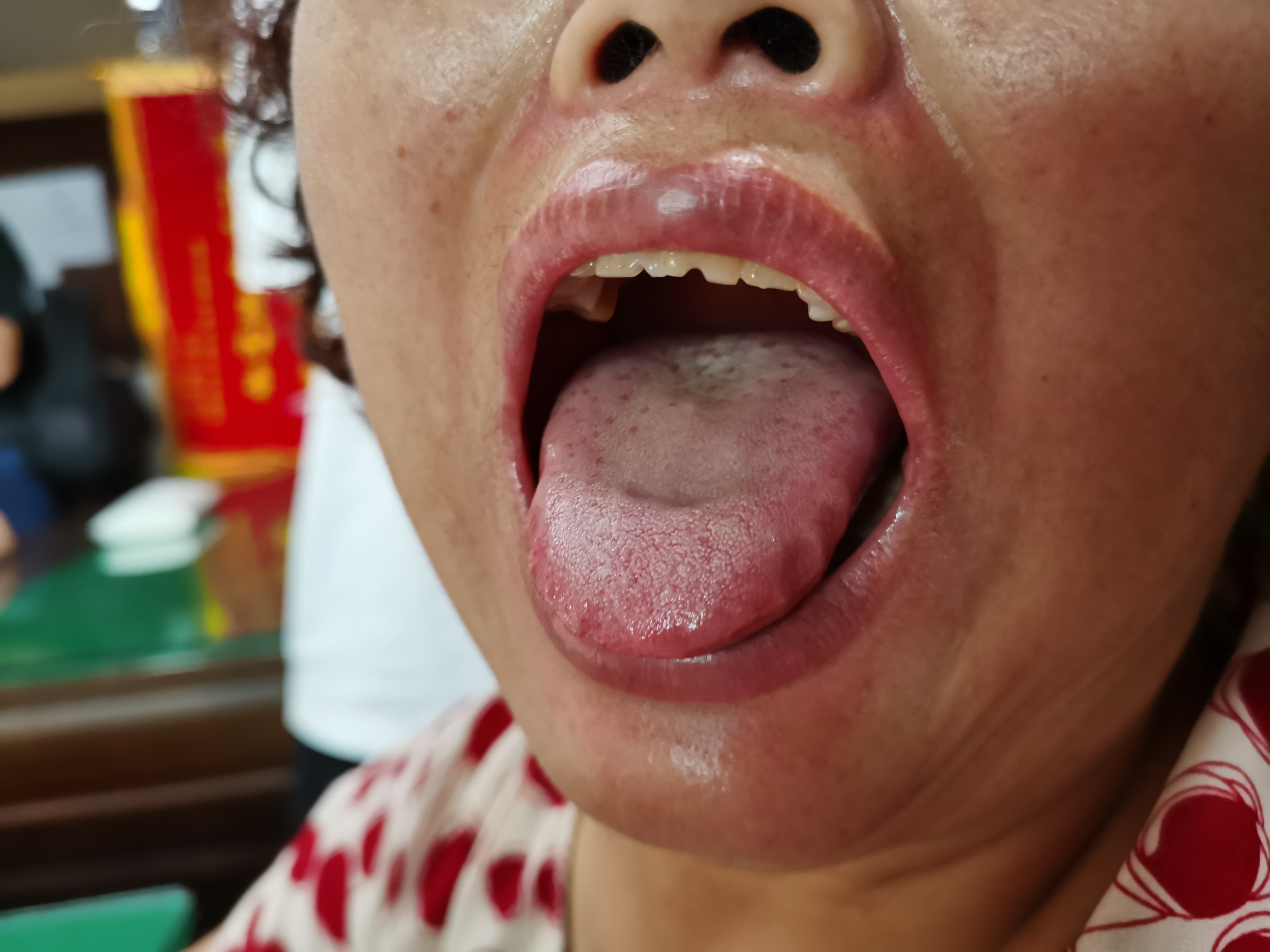 女，49岁，双下肢乏力我7年余 舌面.jpg