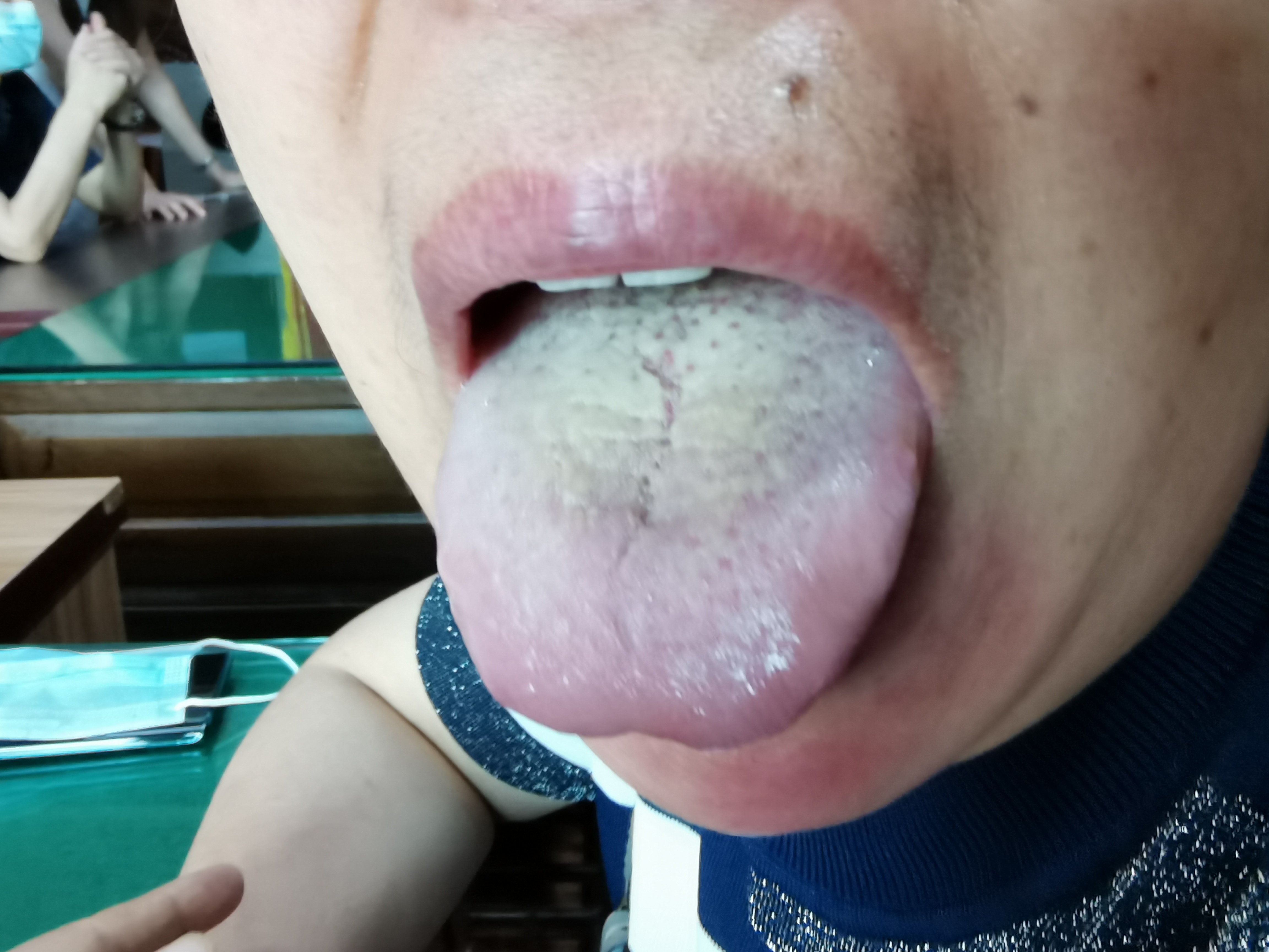 女，53岁，周身浮肿2年，关节疼痛20余年 舌面.jpg